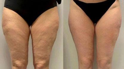 Anti-Cellulite Duo